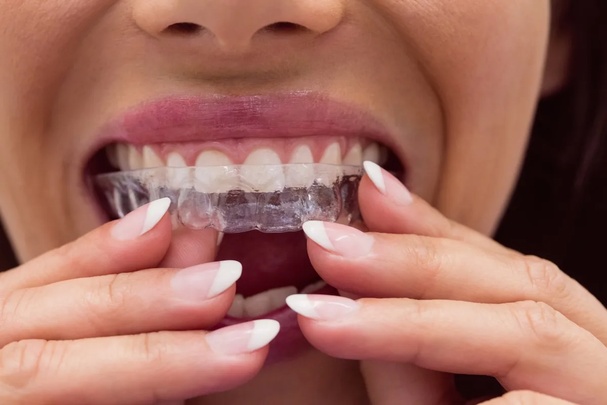 Invisalign Open Week Invisalign Open Day Greenwich — Free Consultation